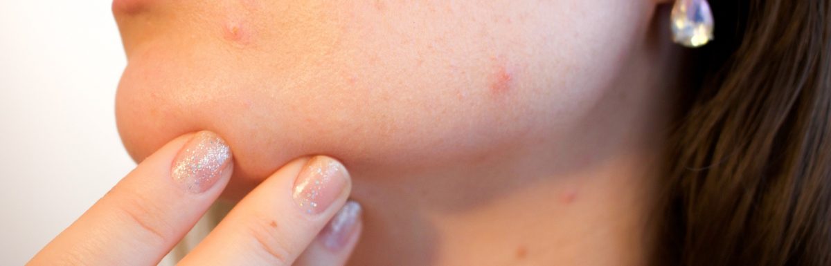 Acne symptoms and treatment
