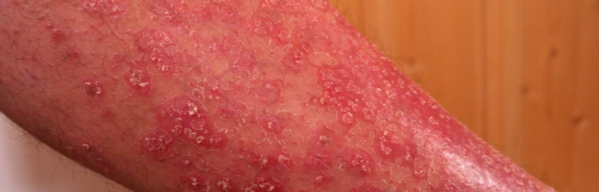 Eczema symptoms and treatment