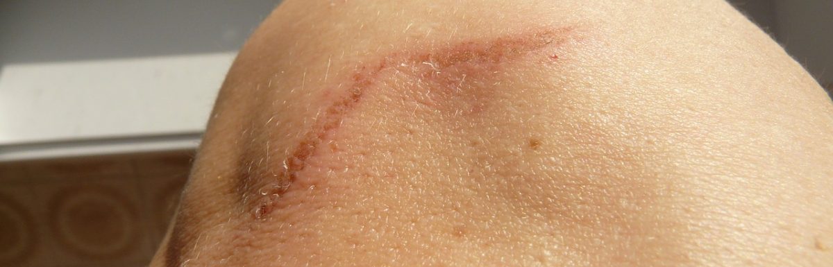 Scar causes and symptoms