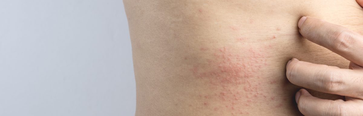 Skin Rash causes and symptoms
