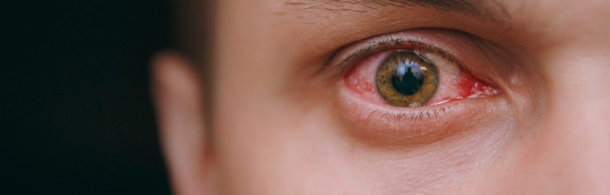 Pink Eye (Conjunctivitis) symptoms and treatment