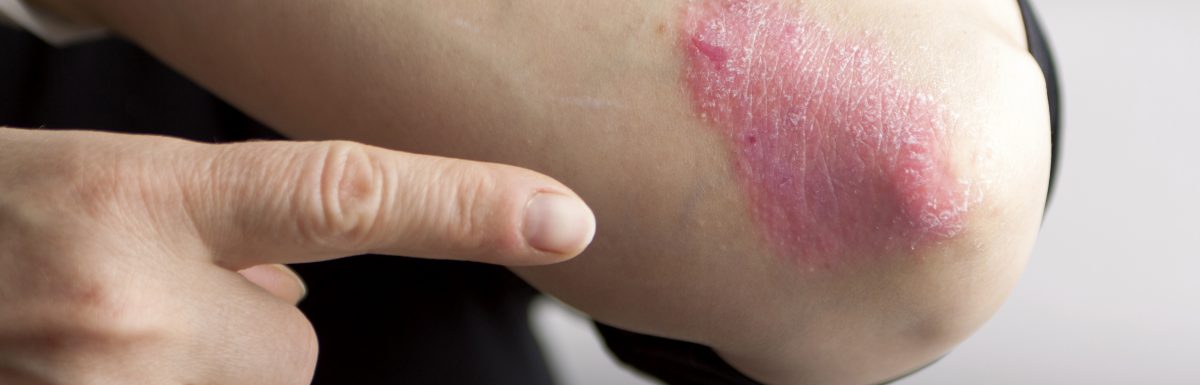 Psoriasis symptoms and treatment