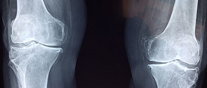 x-ray of knee joints