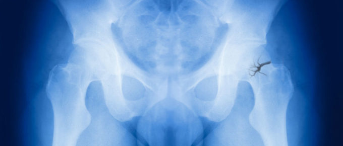 x-ray of pelvis