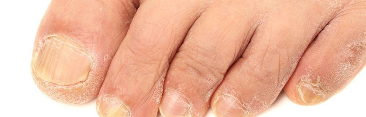 Ranking the best toenail fungus treatments of 2021