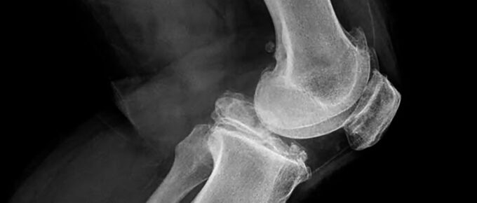 x-ray of knee joint